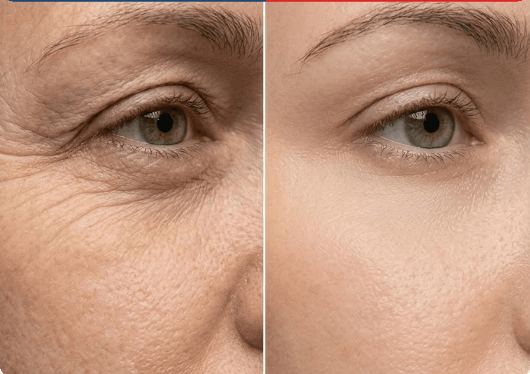 Eye area treatment before and after