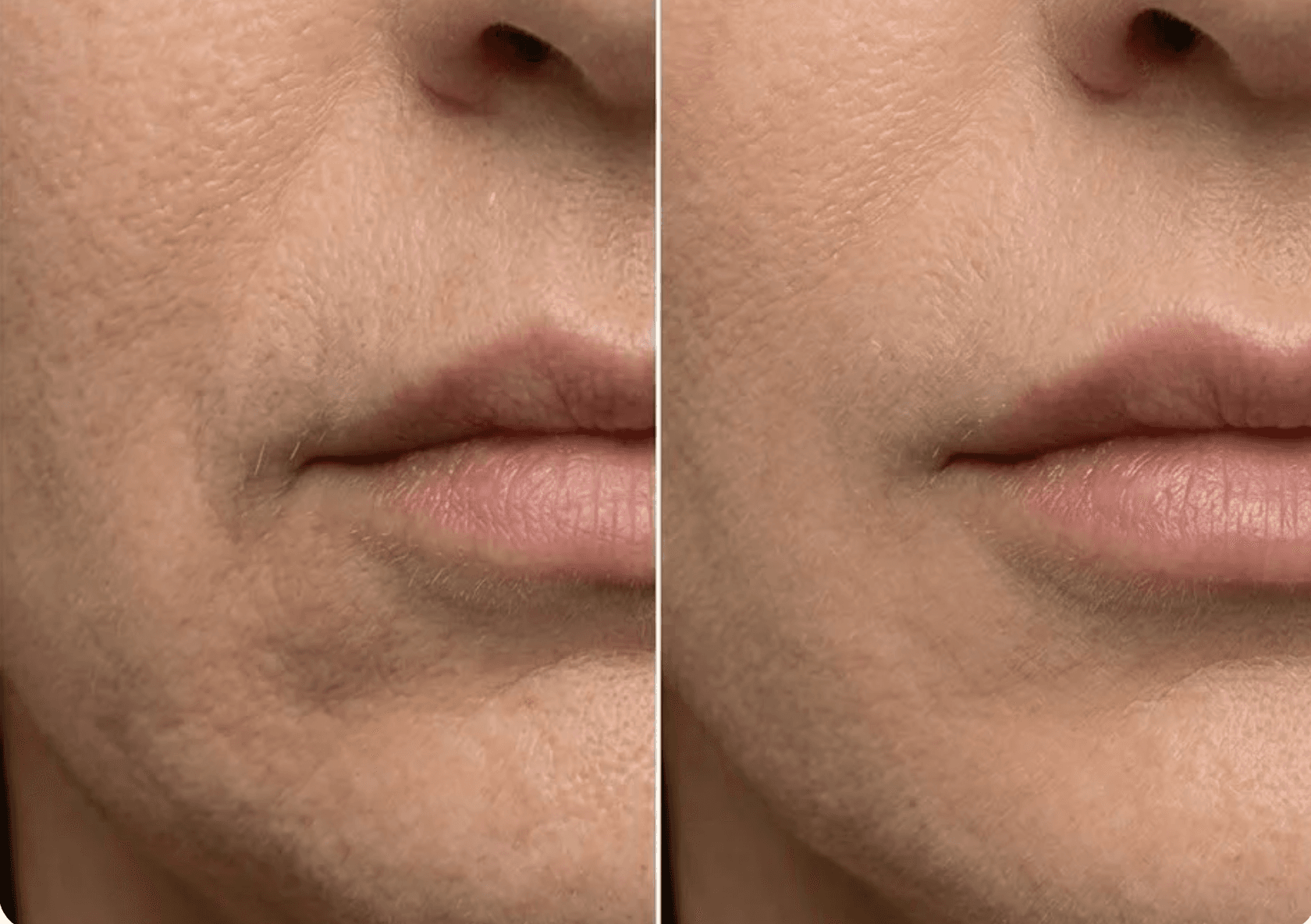 Smile lines treatment before and after